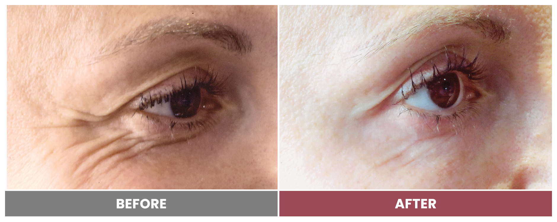 BOTOX FOR WRINKLES & BROW LIFT - Case 10